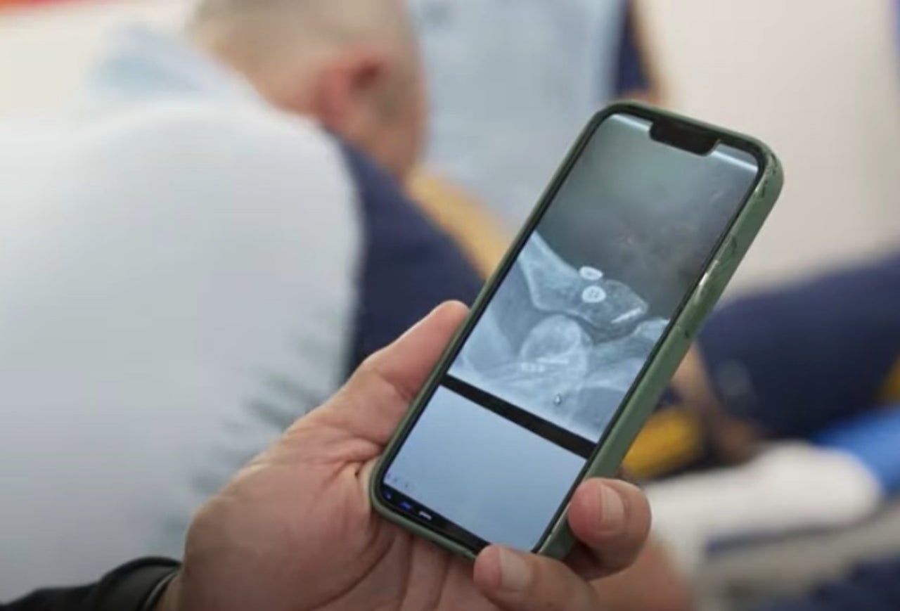 Dani Olmo ensenya la lesió que ha patit a l'espatlla | RFEF