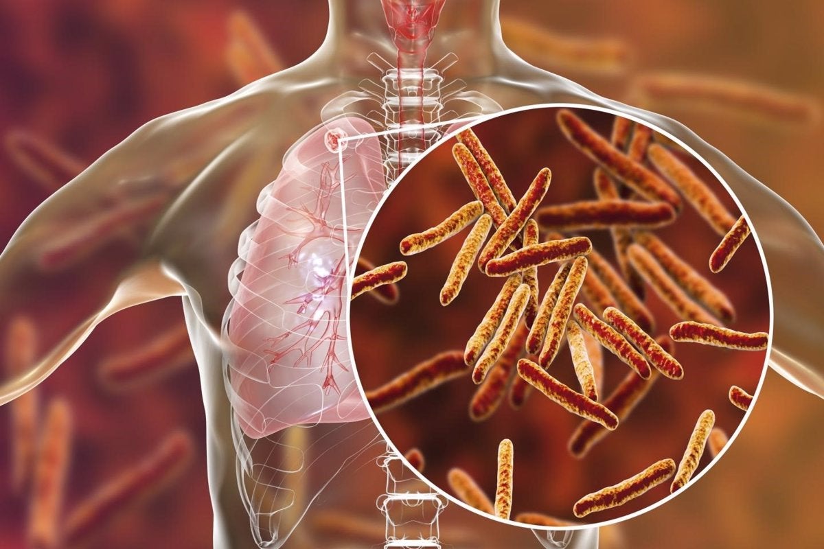 Com afecta la tuberculosi als pulmons | PENN MEDICINE - Europa Press
