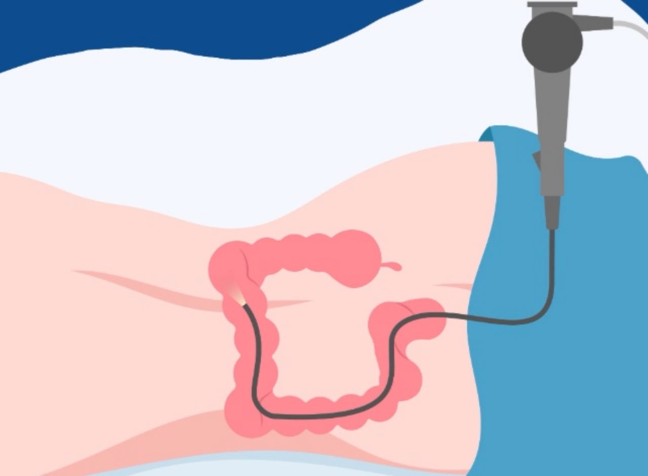 Programa de detecció del càncer de colon i recte | Parc Taulí
